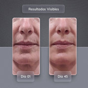 2 x 1 Skindion™ Dispositivo de Rejuvenecimiento Facial